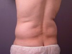 Liposuction Before and after photo