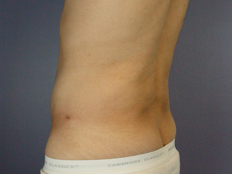 Liposuction before and after photo