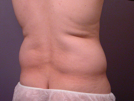 Liposuction before and after photo