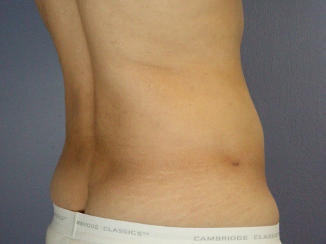 Liposuction before and after photo