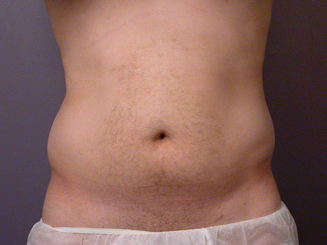 Liposuction before and after photo