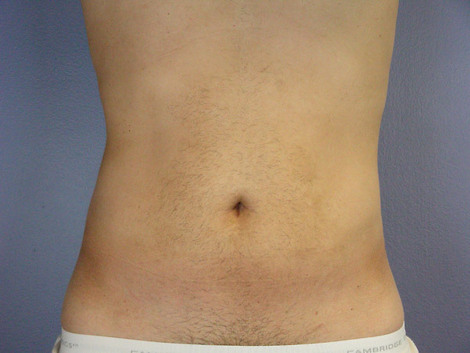 Liposuction before and after photo