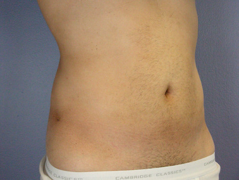 Liposuction before and after photo