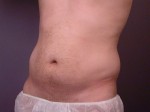 Liposuction Before and after photo