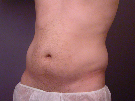 Liposuction before and after photo