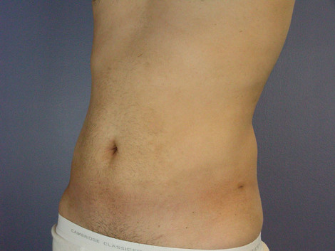 Liposuction before and after photo