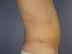 Liposuction Before and after photo