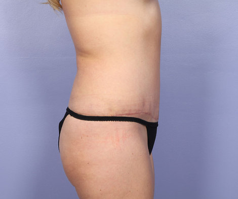 Liposuction before and after photo