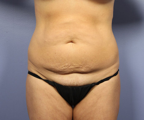 Liposuction before and after photo