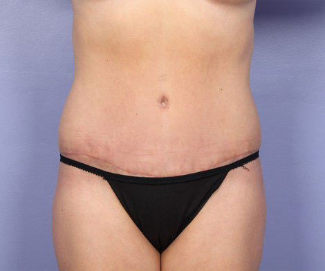 Liposuction before and after photo