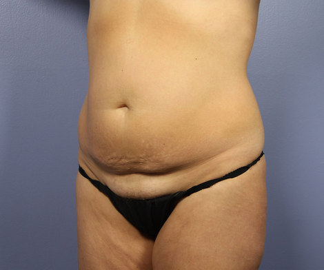 Liposuction before and after photo