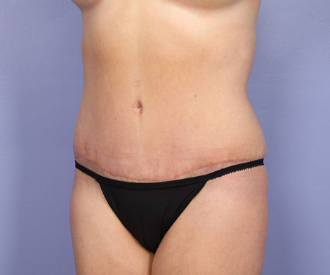 Liposuction before and after photo