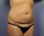 Liposuction Before and after photo