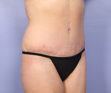 Liposuction before and after photo