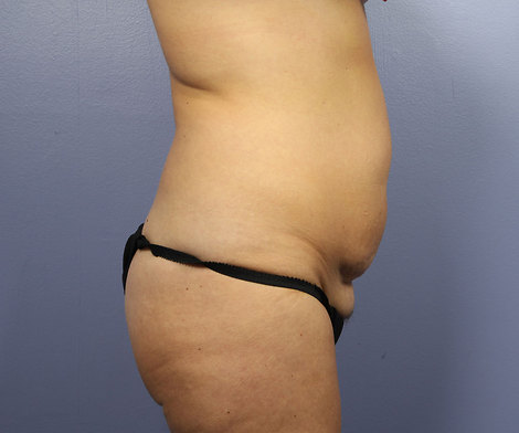 Liposuction before and after photo