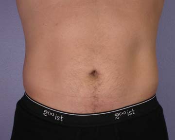 Liposuction before and after photo