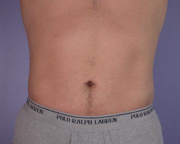 Liposuction before and after photo