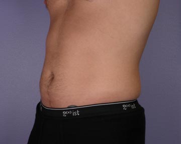 Liposuction before and after photo