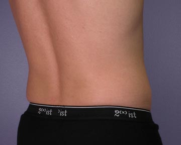 Liposuction before and after photo