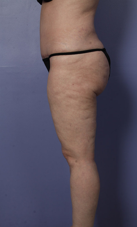 Liposuction before and after photo