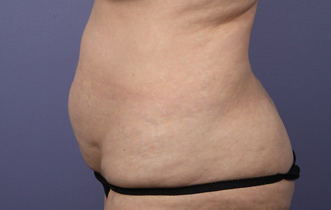 Liposuction before and after photo