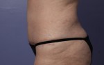 Liposuction Before and after photo