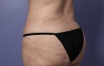 Liposuction Before and after photo