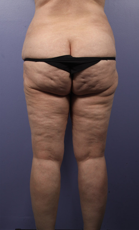 Liposuction before and after photo