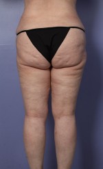 Liposuction Before and after photo