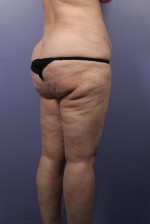 Liposuction Before and after photo