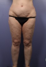 Liposuction