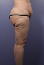 Liposuction Before and after photo