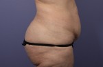 Liposuction Before and after photo