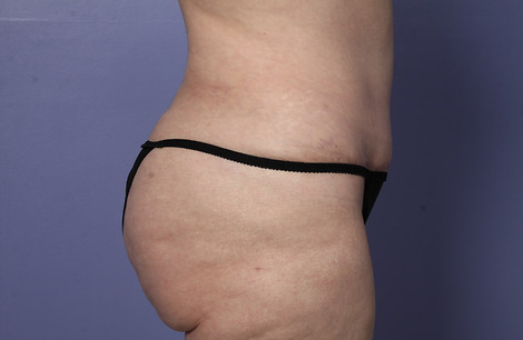 Liposuction before and after photo