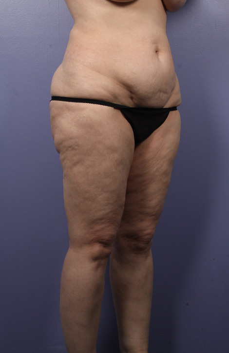 Liposuction before and after photo