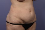 Liposuction Before and after photo