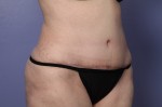 Liposuction Before and after photo