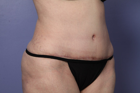 Liposuction before and after photo