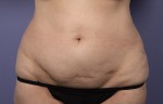 Liposuction