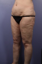 Liposuction Before and after photo