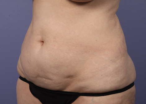 Liposuction before and after photo