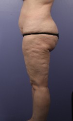 Liposuction Before and after photo