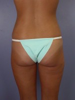 Liposuction Before and after photo