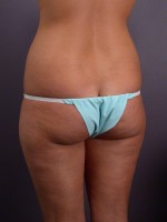 Liposuction Before and after photo