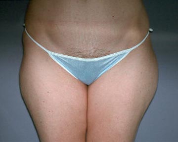 Liposuction before and after photo