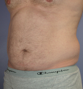 Liposuction before and after photo