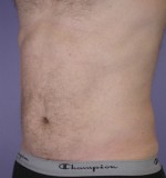 Liposuction