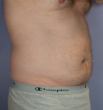 Liposuction Before and after photo