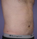 Liposuction Before and after photo