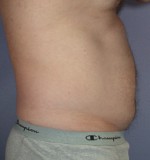 Liposuction Before and after photo